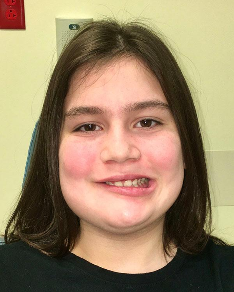 Photo of Grace Moss before surgery to remove her ameloblastoma, a benign, but aggressive, localized tumor on her lower right jaw. (Photo courtesy of UTHealth)